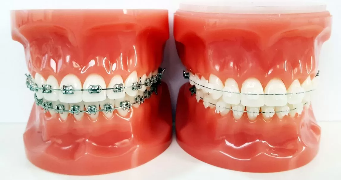 clear braces for adults